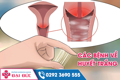 Các bệnh về huyết trắng mà bạn cần biết